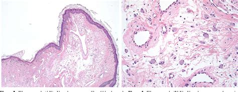 Fibrous Papule Histology