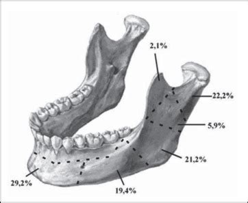 Schematic representation of the mandible fracture reductions according ...