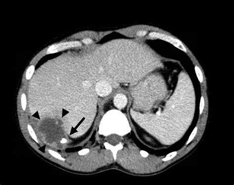 Chronically Retained Fecalith following Laparoscopic Appendectomy | Surgical Infections Case Reports