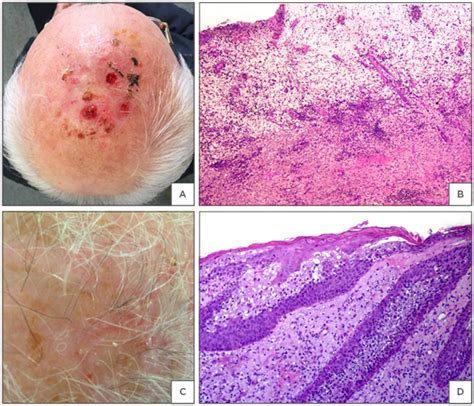 Erosive Pustular Dermatosis of The Scalp: A Neutrophilic Folliculitis Within the Spectrum of ...