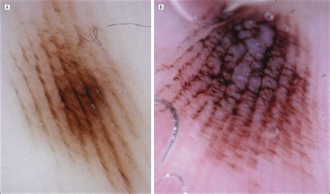 Dermoscopic Patterns of Acral Melanocytic Nevi | Dermatology | JAMA ...