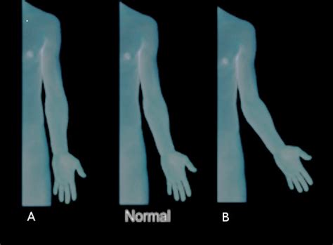 [Figure, cubitus varus and valgus Image courtesy S Bhimji MD ...