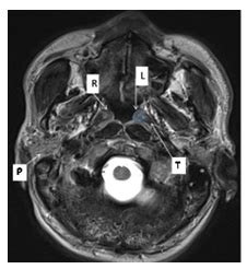 Minor Salivary Glands and ‘Tubarial Glands’-Anatomy, Physiology, and Pathology Relevant to Radiology