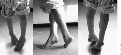 Figure 1 from Progressive Dynamic Equinovarus Deformity in Hereditary Spastic Paraplegia - A ...