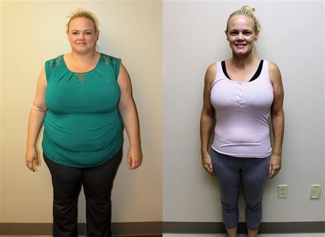 Gastric Sleeve Before and After in St. Louis | St Louis Bariatrics