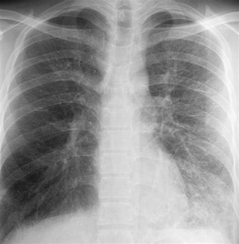 Acute eosinofiele pneumonie | Tech Blog