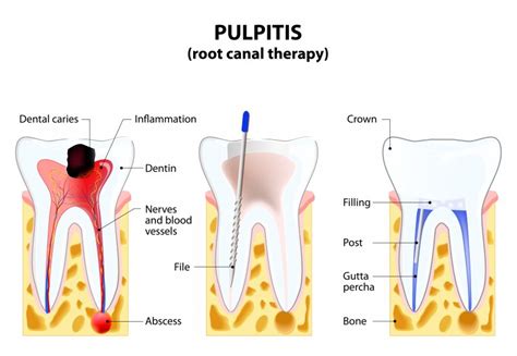 What’s the Truth When It Comes to Root Canal Myths | Pearl Dentistry