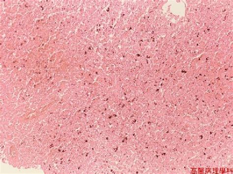 KMU Pathology Lab《Slide 11.》Malaria pigment (Hemozoin), Liver