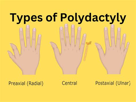 The Fascinating World of a Genetic Abnormality: Polydactyly — CHELSIDERMY | Oddities, bones, art ...