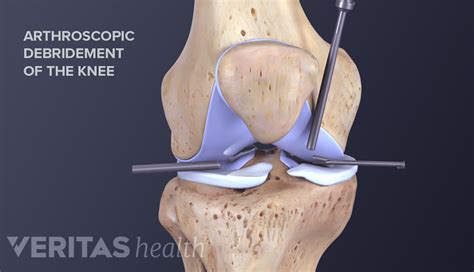 Surgery for Knee Hyperextension | Sports-health