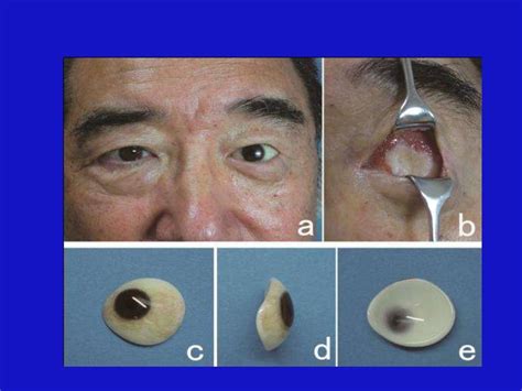 Contracted eye socket reconstruction