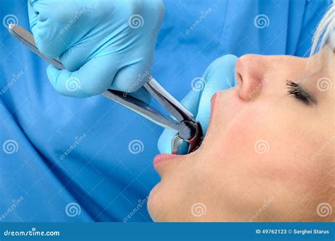 Tooth Extraction By Dentist Using Forceps Stock Photo | CartoonDealer.com #9867882