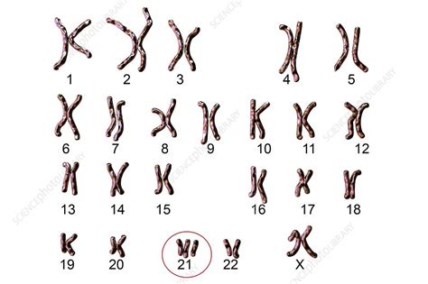 Down's syndrome karyotype, illustration - Stock Image - F013/4421 - Science Photo Library