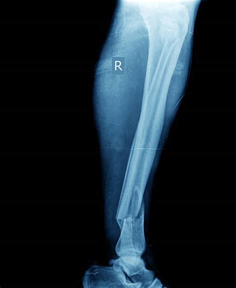 Best Broken Leg Xray Stock Photos, Pictures & Royalty-Free Images - iStock