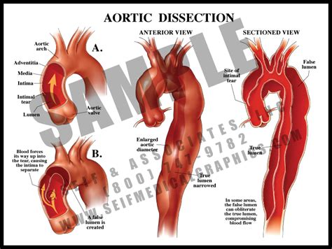 Aortic Dissection - S&A Medical Graphics