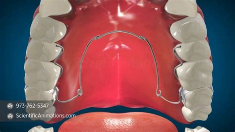 Orthodontic Appliances - Quad Helix on Vimeo