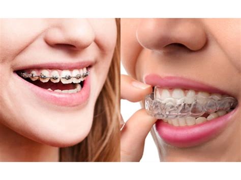 Braces vs. Invisalign: Which Teeth-Straightening Mechanism Is Best For ...