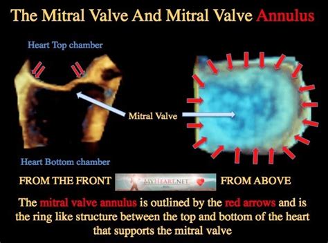 Mitral Annular Calcification: Diagnosis, Treatment, & Risks