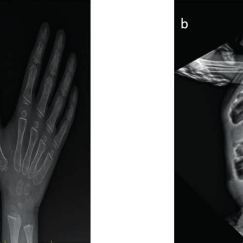 Dysostosis multiplex of hands and vertebra. a. indicates irregularities ...