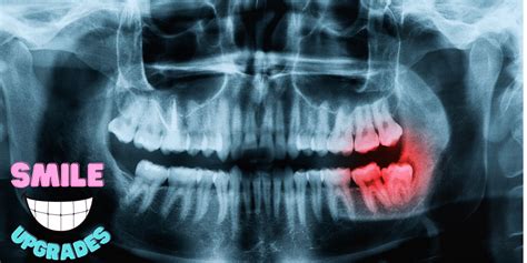 What do Wisdom Teeth Stitches Look Like: Types & Care Guide