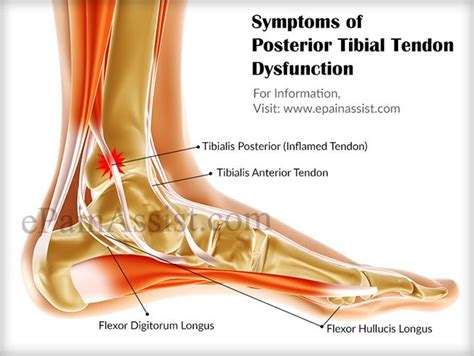 Symptoms of Tibialis Posterior Syndrome or Posterior Tibial Tendon ...