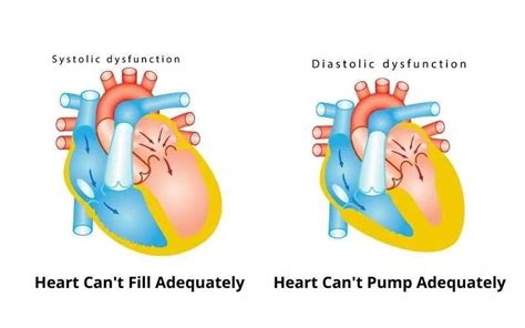 Systolic Heart Failure vs Diastolic Heart Failure: Symptoms, Diagnosis, Treatment, and Prognosis ...