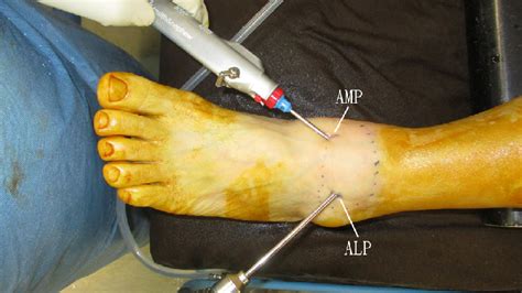 Combined arthroscopic and endoscopic synovectomy for diffuse pigmented ...