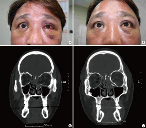 Orbital Floor Fracture Non Out - Carpet Vidalondon