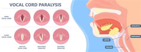 Vocal Cord Paralysis: Causes, Symptoms And Treatment