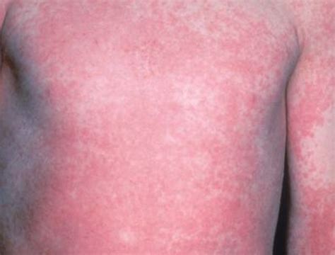 Scarlet Fever - Pictures, Symptoms, Rash, Contagious, Treatment, Causes