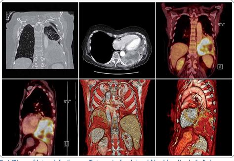 Figure 2 from Sarcomatoid carcinoma of the lung - a case report ...