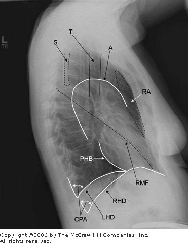 Phrenico Pericardial Ligament - riecripe