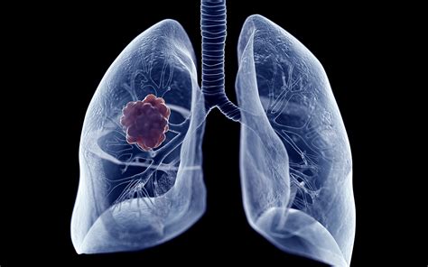 Lung cancer: pay attention to never smok... | DayBreakWeekly UK