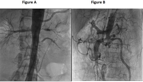 Takayasu's arteritis - a comprehensive review