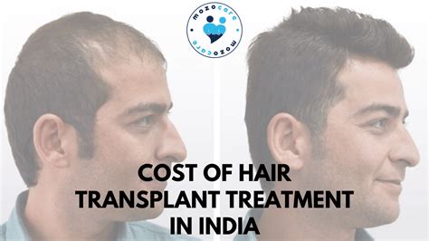 What is the Hair Transplant Cost in India? | Fue , Fut , Grafts | Mozocare