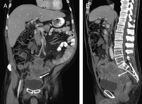 Vesicocolic Fistula Detected by 99mTc-MAG3 Renogram : Clinical Nuclear ...