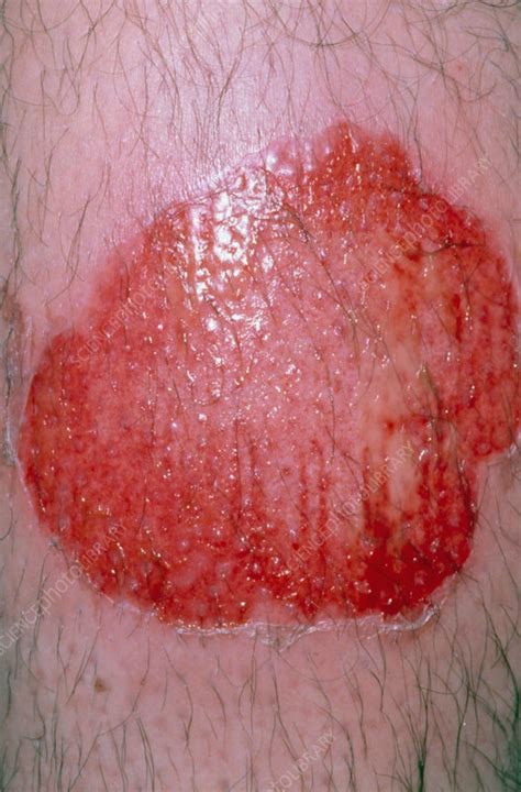 Close-up of infected leg burn from steam cleaner - Stock Image - M335 ...