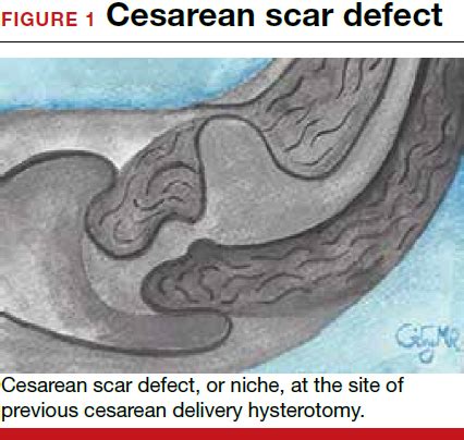 Cesarean Section Scar / 10 Powerful Photos Of Moms Showing Off Their C Section Scars / However ...