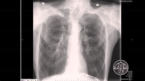 Xray Interpretation - COPD - YouTube