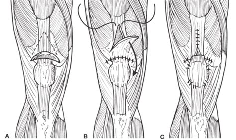 Management of Extensor Mechanism Ruptures | Musculoskeletal Key