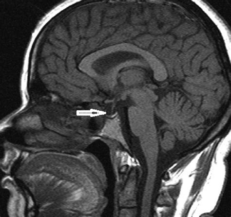 Magnetic resonance image of brain sagittal view showing empty sella | Download Scientific Diagram