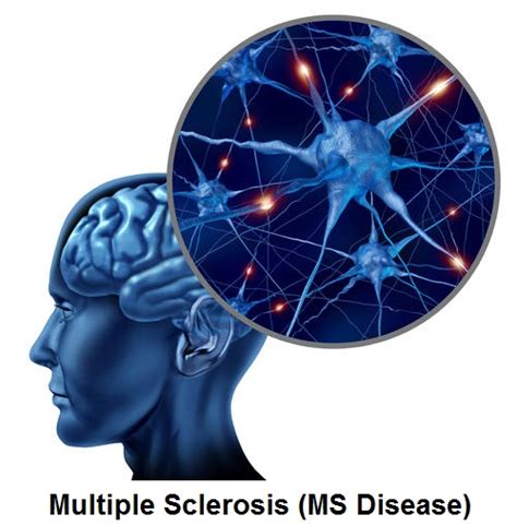 Multiple Sclerosis (MS Disease): Signs And Symptoms, Diagnosis And ...