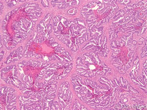 Lung Adenocarcinoma Histology