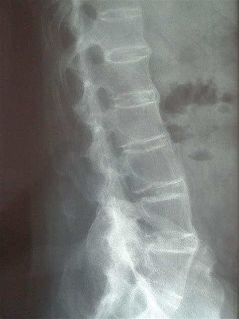 Ankylosing Spondylitis Bamboo Spine