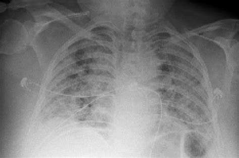 Artificial Intelligence Tool Uses Chest X-Rays to Differentiate Worst Cases of COVID-19 | NYU ...