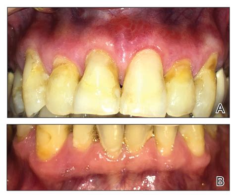 Linear Gingival Erythema