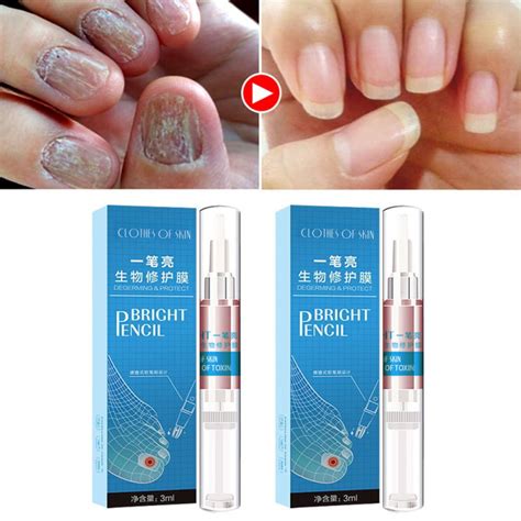 Toenail Fungus Treatment Antibacterial Nail Repair Care Pen Anti-fungal Treatment - Walmart.com