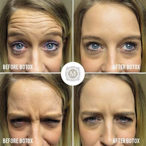 This patient had 20 units of Botox for forehead wrinkles, frown lines ...