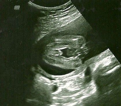 Ultrasound pictures of gender - BabyCenter