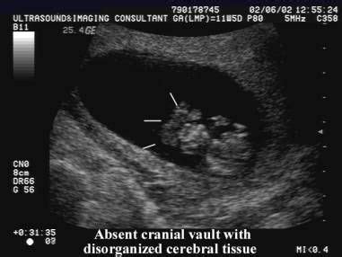 Ultrasound of Anencephaly | Ultrasound, Obstetrics, Abnormal